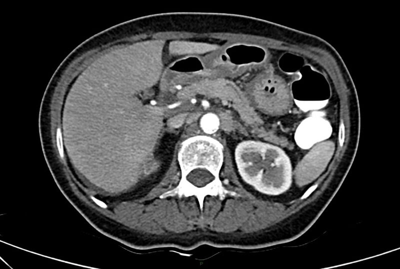 File:Carcinoid mesenteric tumor complicated by chylous ascites (Radiopaedia 76312-88926 A 22).jpg