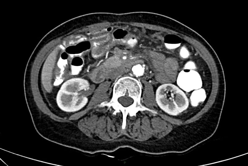 File:Carcinoid mesenteric tumor complicated by chylous ascites (Radiopaedia 76312-88926 A 34).jpg