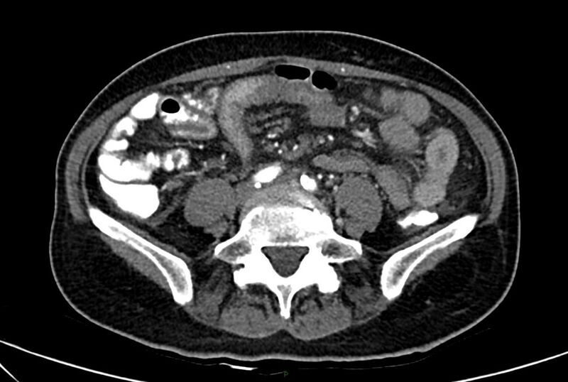 File:Carcinoid mesenteric tumor complicated by chylous ascites (Radiopaedia 76312-88926 A 46).jpg