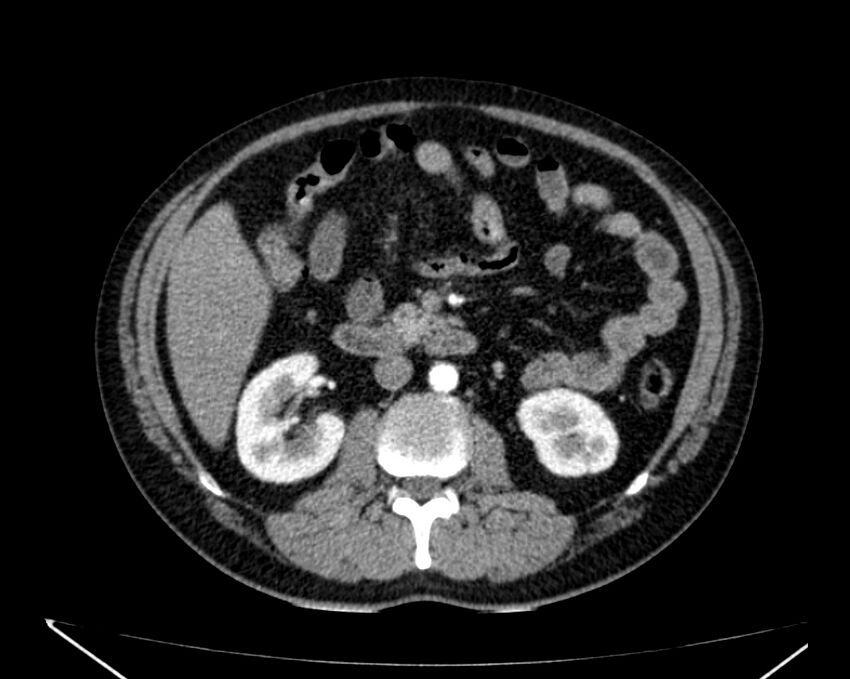 Carcinoid tumor with hepatic metastases (Radiopaedia 22651-22670 B 40).jpg