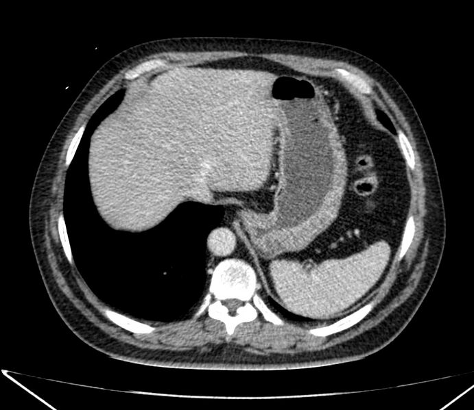 File:Carcinoid tumor with hepatic metastases (Radiopaedia 22651-22670 C 31).jpg