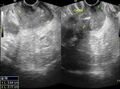 Carcinoma of the cervix - squamous cell (Radiopaedia 30432-31097 C 1).jpg