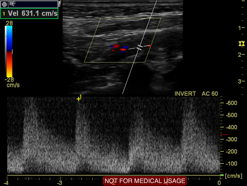 File:Carotid artery stenosis (Radiopaedia 28786-29088 M 1).png