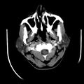 Carotid body tumor (Radiopaedia 27890-28124 A 7).jpg