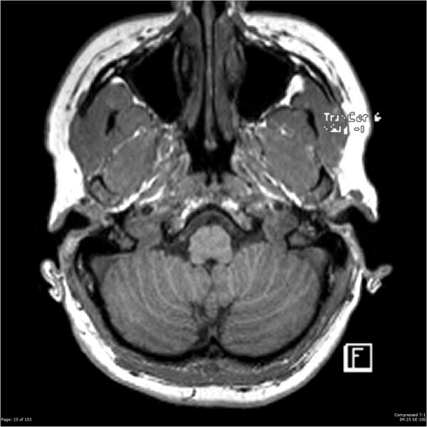 File:Cavernous malformation (cavernous angioma or cavernoma) (Radiopaedia 36675-38237 Axial T1 14).jpg