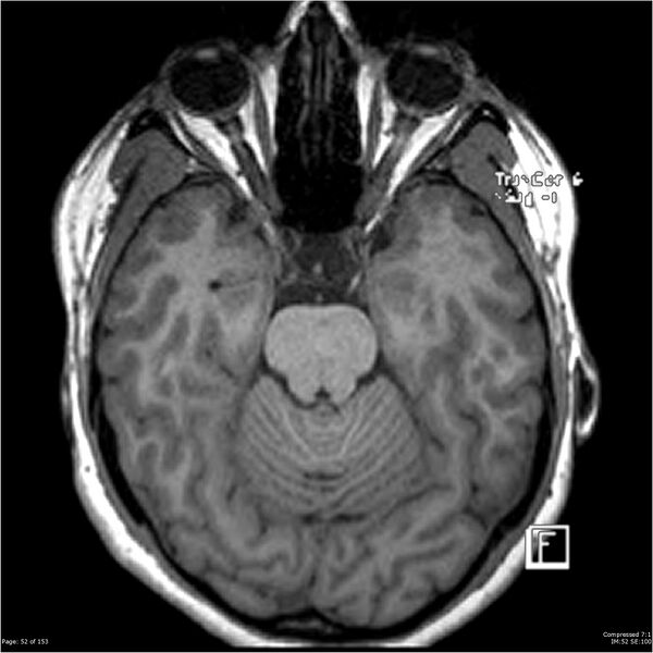 File:Cavernous malformation (cavernous angioma or cavernoma) (Radiopaedia 36675-38237 Axial T1 41).jpg