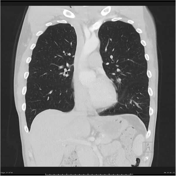 File:Cavitating lung cancer (Radiopaedia 25796-25945 lung window 17).jpg