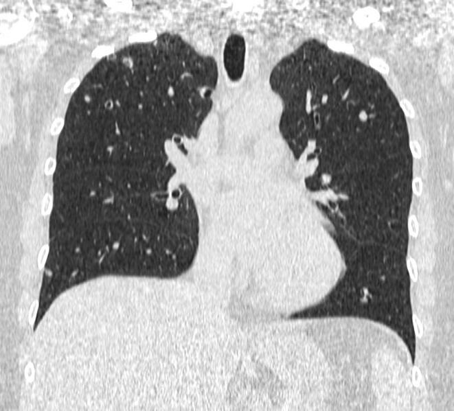 File:Cavitating pulmonary metastases (Radiopaedia 17796-17555 Coronal lung window 11).jpg