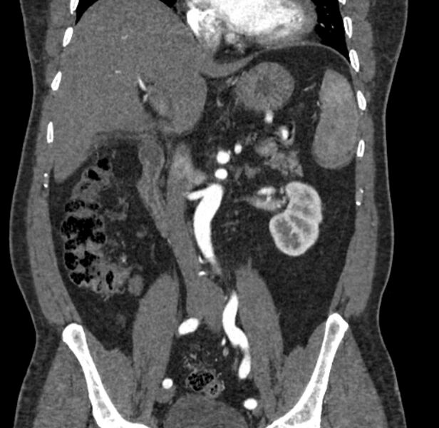 File:Celiac artery dissection (Radiopaedia 52194-58080 C 59).jpg