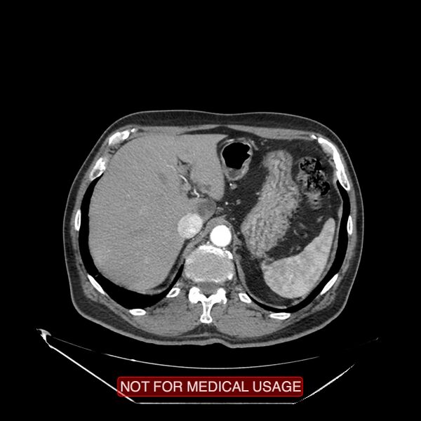 File:Celiac trunk variant anatomy - gastrohepatic trunk and splenic artery (Radiopaedia 38815-40995 A 3).jpg