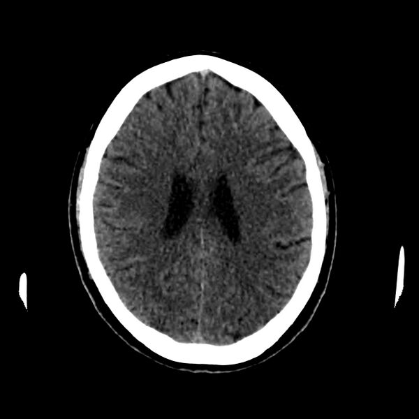 File:Central nervous system Langerhans cell histiocytosis (Radiopaedia 65728-74878 Axial non-contrast 34).jpg