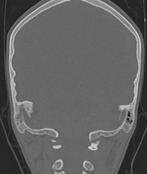 File:Cerebellar abscess (Radiopaedia 73727-84527 Coronal bone window 31).jpg