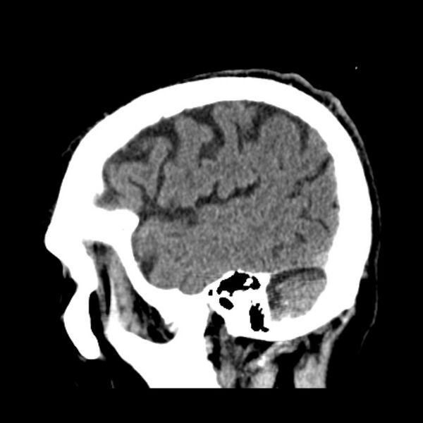 File:Cerebellar hemorrhage (Radiopaedia 27193-27359 C 9).jpg