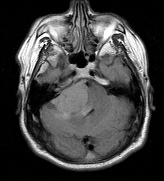 File:Cerebellopontine angle meningioma (Radiopaedia 24459-24764 Axial FLAIR 7).jpg