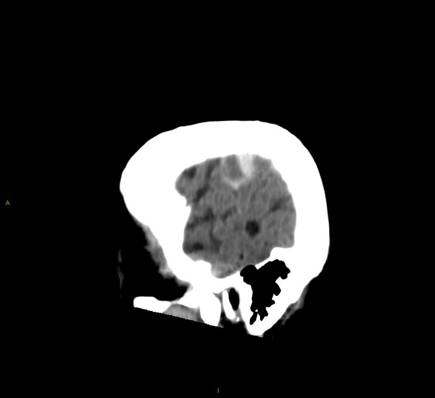 Cerebral amyloid angiopathy-associated lobar intracerebral hemorrhage (Radiopaedia 58376-65513 C 18).jpg