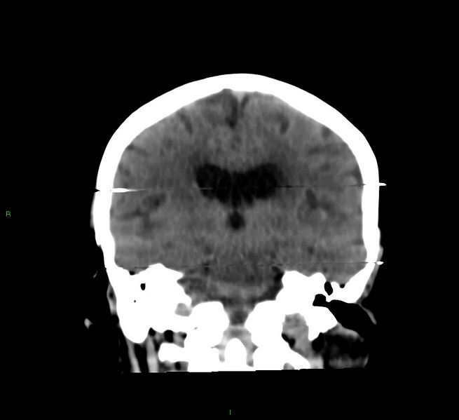 File:Cerebral amyloid angiopathy-associated lobar intracerebral hemorrhage (Radiopaedia 58377-65514 Coronal non-contrast 31).jpg