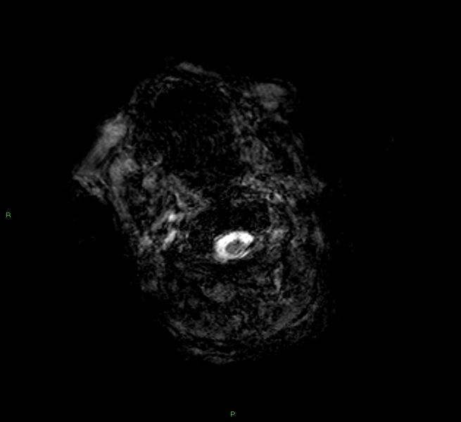 File:Cerebral amyloid angiopathy-associated lobar intracerebral hemorrhage (Radiopaedia 58377-65515 Axial Gradient Echo 26).jpg
