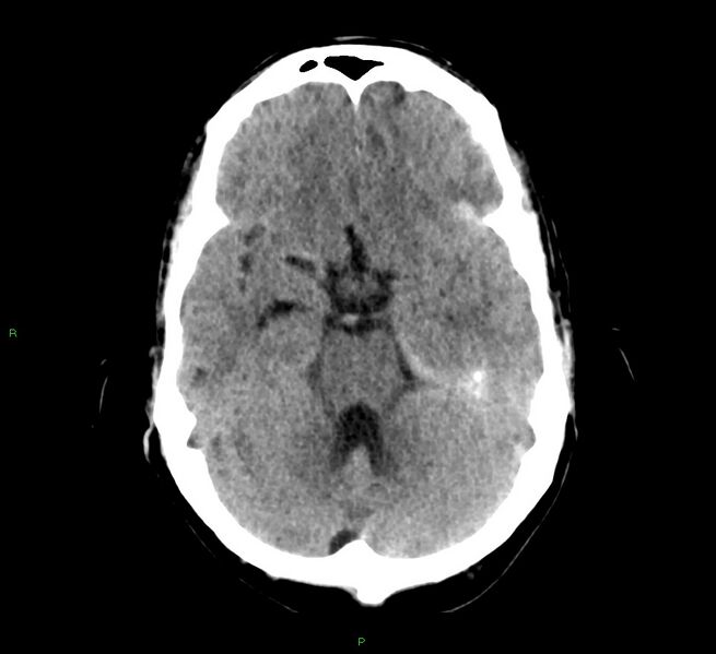 File:Cerebral amyloid angiopathy-associated lobar intracerebral hemorrhage (Radiopaedia 58529-65687 Axial non-contrast 35).jpg