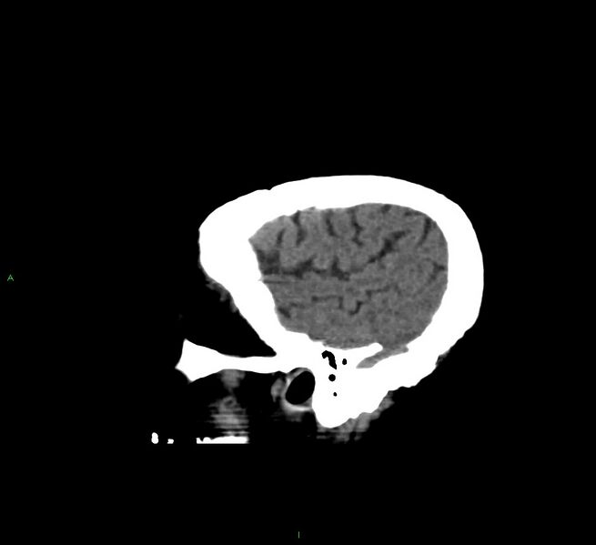 File:Cerebral amyloid angiopathy-associated lobar intracerebral hemorrhage (Radiopaedia 58560-65723 C 45).jpg