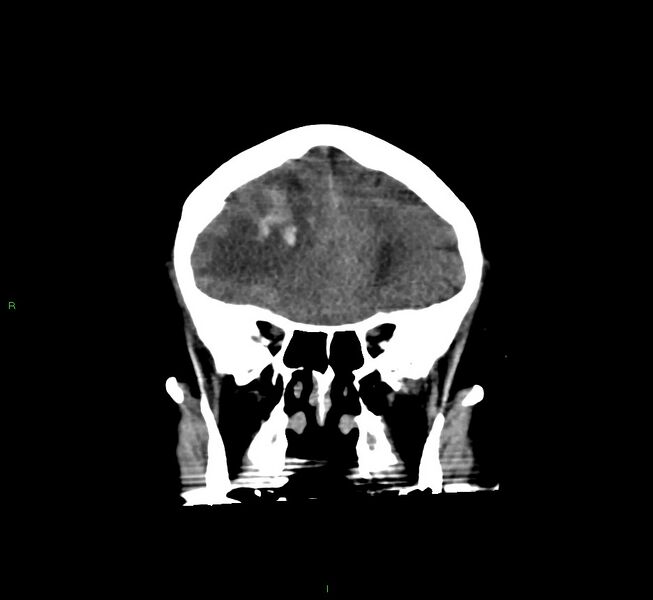File:Cerebral amyloid angiopathy-associated lobar intracerebral hemorrhage (Radiopaedia 58560-65723 Coronal non-contrast 51).jpg