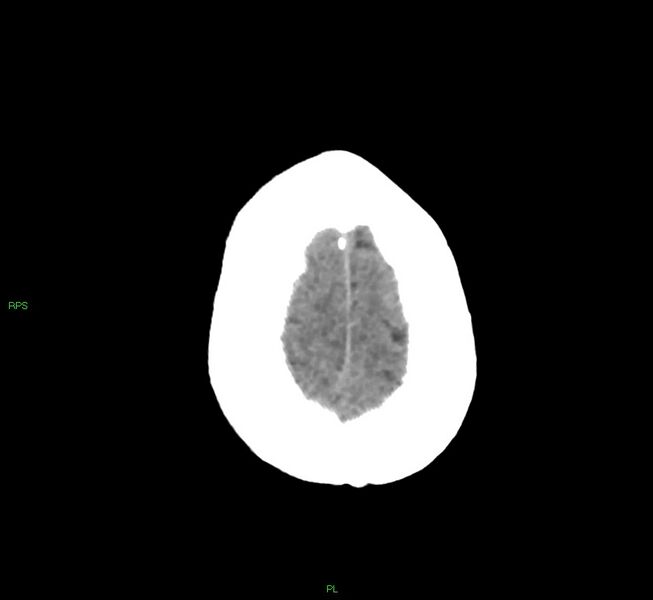 File:Cerebral amyloid angiopathy-associated lobar intracerebral hemorrhage (Radiopaedia 58569-65734 Axial non-contrast 13).jpg