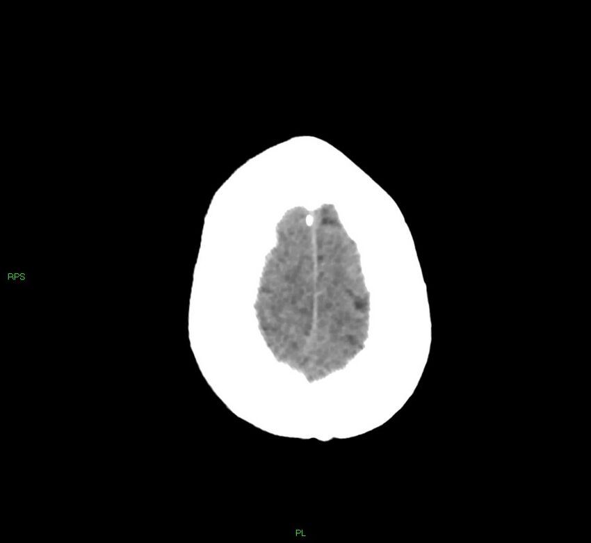 Cerebral amyloid angiopathy-associated lobar intracerebral hemorrhage (Radiopaedia 58569-65734 Axial non-contrast 13).jpg