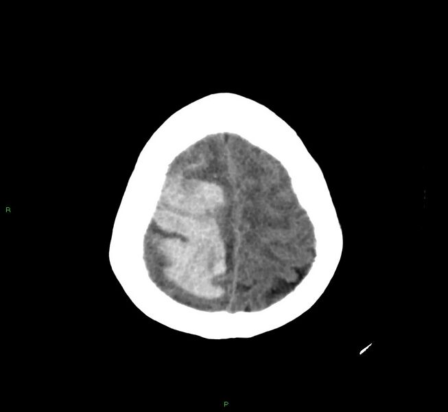 File:Cerebral amyloid angiopathy-associated lobar intracerebral hemorrhage (Radiopaedia 58751-65972 Axial non-contrast 10).jpg