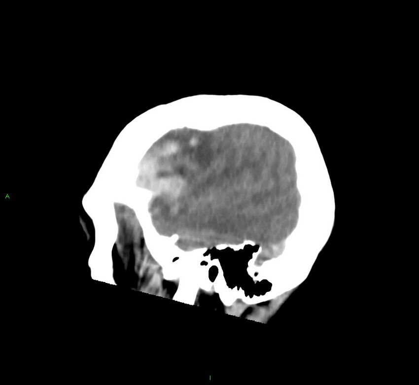 Cerebral amyloid angiopathy-associated lobar intracerebral hemorrhage (Radiopaedia 58752-65973 C 44).jpg
