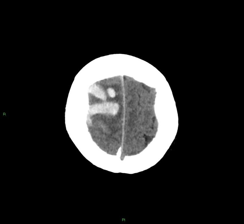 Cerebral amyloid angiopathy-associated lobar intracerebral hemorrhage (Radiopaedia 58756-65977 Axial non-contrast 10).jpg