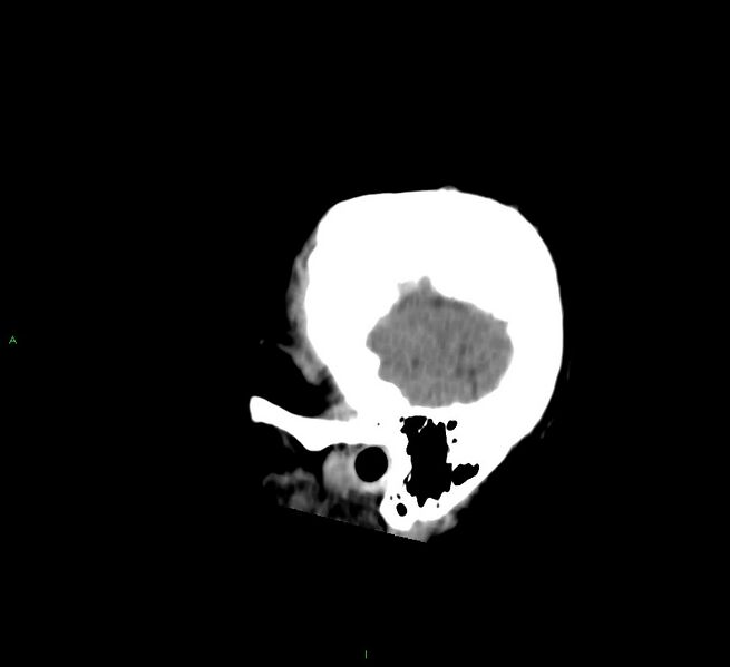 File:Cerebral amyloid angiopathy-associated lobar intracerebral hemorrhage (Radiopaedia 58756-65977 C 52).jpg