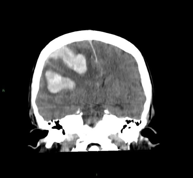 File:Cerebral amyloid angiopathy-associated lobar intracerebral hemorrhage (Radiopaedia 58756-65977 Coronal non-contrast 36).jpg