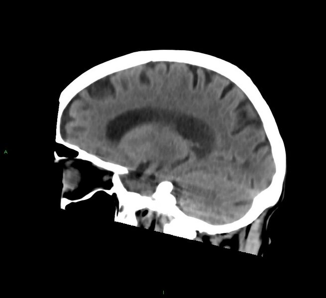 File:Cerebral amyloid angiopathy-associated lobar intracerebral hemorrhage (Radiopaedia 58758-65980 C 35).jpg