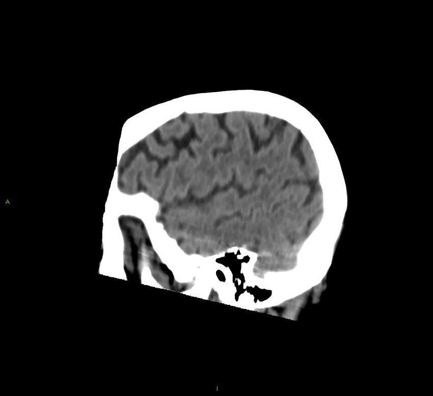 Cerebral amyloid angiopathy-associated lobar intracerebral hemorrhage (Radiopaedia 58758-65980 C 44).jpg