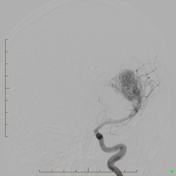 File:Cerebral arteriovenous malformation (AVM) (Radiopaedia 78162-90707 C 7).jpg