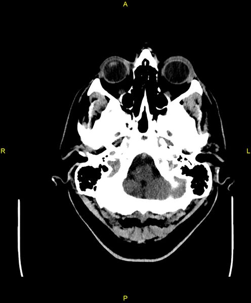 File:Cerebral autosomal dominant arteriopathy with subcortical infarcts and leukoencephalopathy (CADASIL) (Radiopaedia 86108-102051 Axial non-contrast 12).jpg