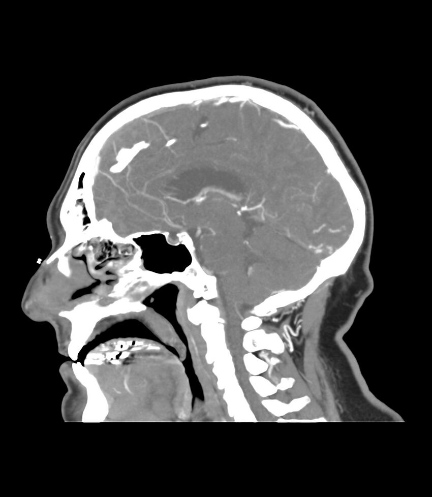 Cerebral dural venous sinus thrombosis (Radiopaedia 86514-102576 C 30).jpg