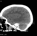 Cerebral hemorrhagic contusion with subdural and subarachnoid hemorrhage (Radiopaedia 10680-11146 C 3).jpg