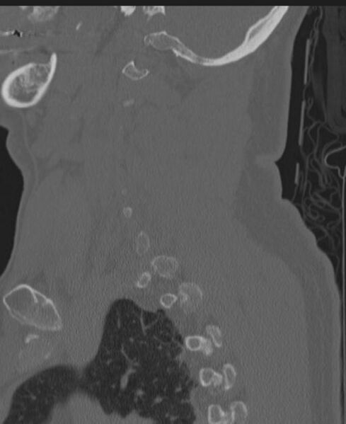 File:Cerebral hemorrhagic contusions and cervical spine fractures (Radiopaedia 32865-33841 Sagittal bone window 73).jpg