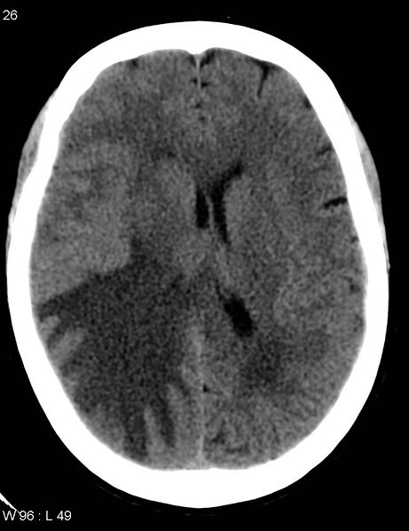 File:Cerebral metastasis - lung cancer (Radiopaedia 5315-7072 Axial non-contrast 5).jpg