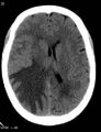 Cerebral metastasis - lung cancer (Radiopaedia 5315-7072 Axial non-contrast 5).jpg