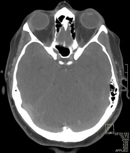 File:Cerebral venous sinus thrombosis (Radiopaedia 91329-108965 Axial venogram 30).jpg