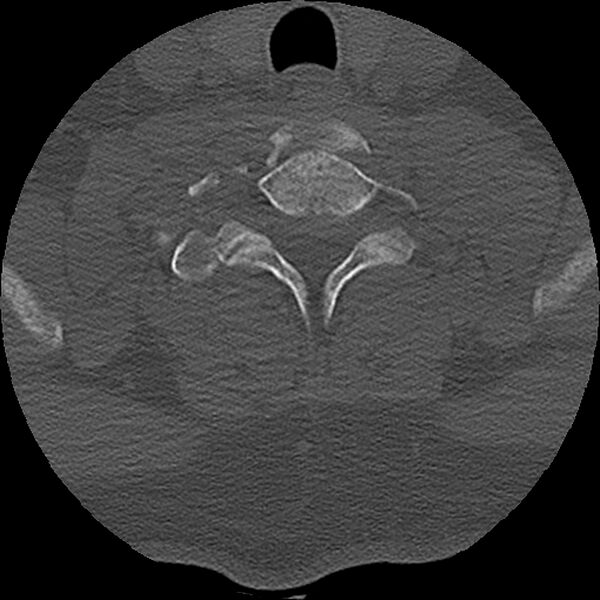 File:Cervical fracture and dislocation with locked facet (Radiopaedia 31837-32780 Axial bone window 18).jpg