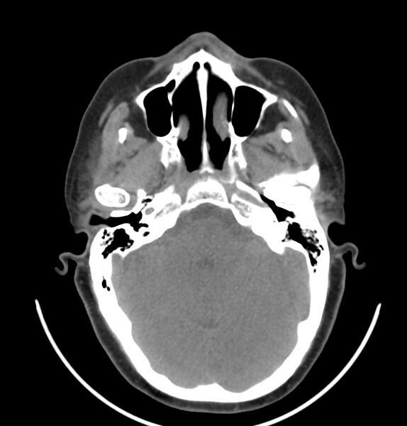 File:Cervical lymphadenopathy- cause unknown (Radiopaedia 22420-22457 non-contrast 39).jpg