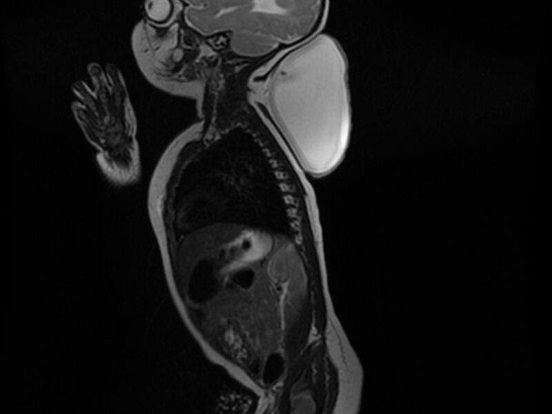 File:Cervical myelomeningocele (Radiopaedia 69569-79479 Sagittal T2 12).jpg