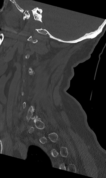 File:Cervical spine fracture - chalk stick (Radiopaedia 39116-41323 Sagittal bone window 17).png