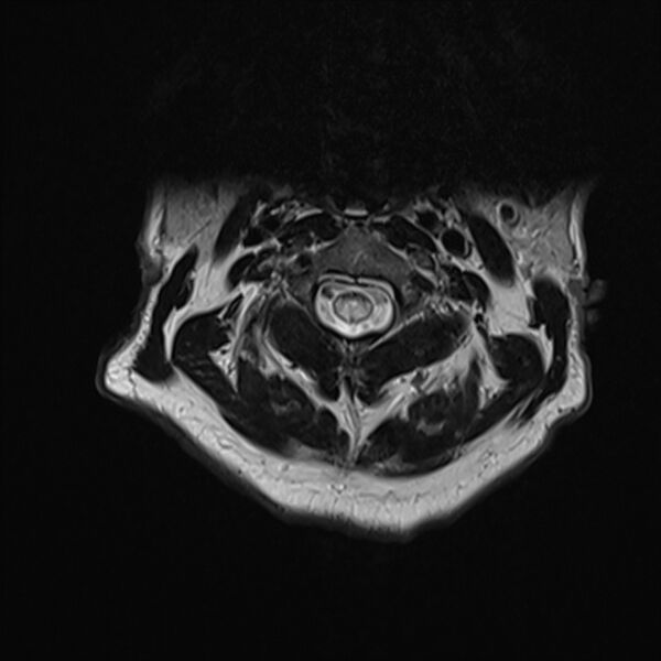 File:Cervical tumor-like myelopathy due to Type V dAVF (Radiopaedia 82461-96604 Axial T2 9).jpg
