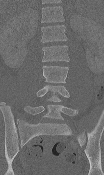 File:Chance fracture (Radiopaedia 40360-42912 Coronal bone window 31).png
