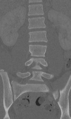 Chance fracture (Radiopaedia 40360-42912 Coronal bone window 31).png