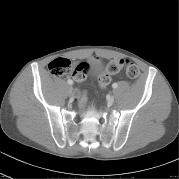File:Chest and abdomen multi-trauma (Radiopaedia 26294-26426 A 68).jpg