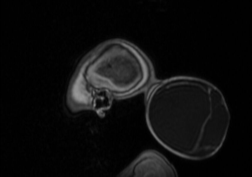 Chiari III malformation with occipital encephalocele (Radiopaedia 79446-92559 Sagittal T1 C+ mpr 13).jpg